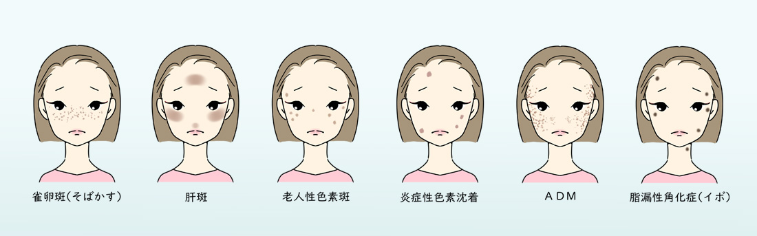 シミの種類とおすすめのシミ取り施術！