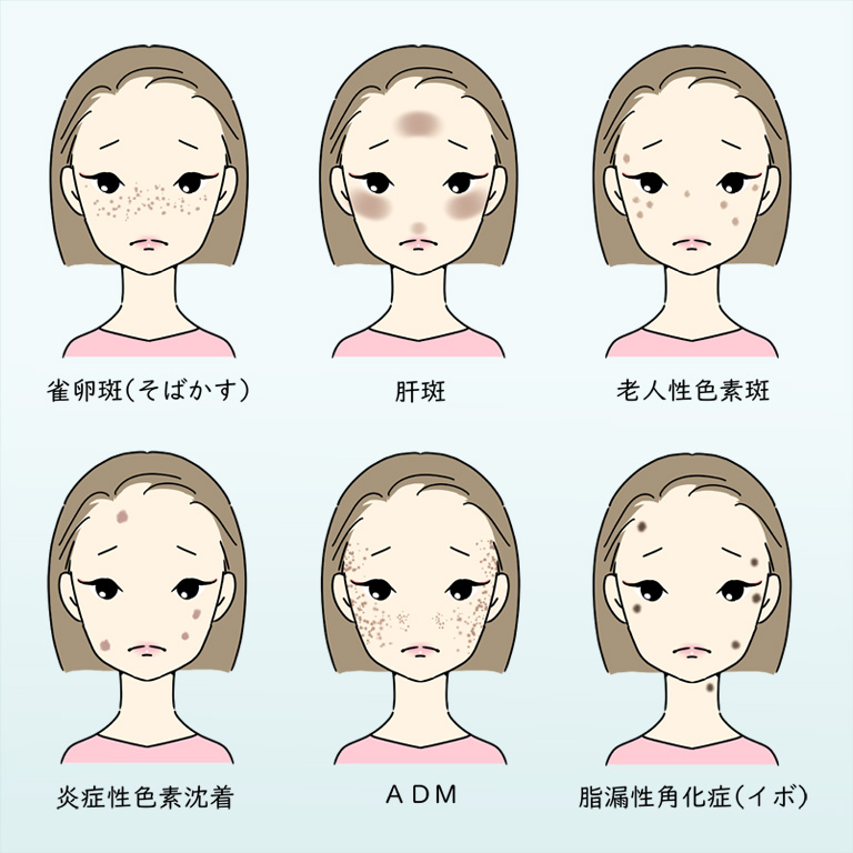 シミの種類とおすすめのシミ取り施術！