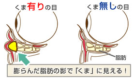 膨らんだ脂肪の影で「くま」に見える！