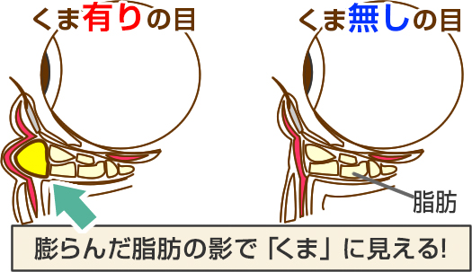 膨らんだ脂肪の影で「くま」に見える!