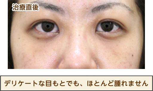 デリケートな目もとでも、ほとんど腫れません