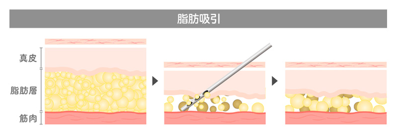 【脂肪吸引とはどのような施術ですか？