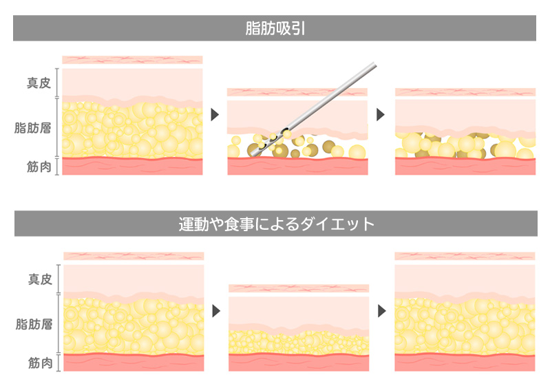 脂肪吸引とダイエットの違いは何ですか？