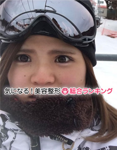 2017年3月のななさん（当時20歳）二重切開後で目頭切開前
