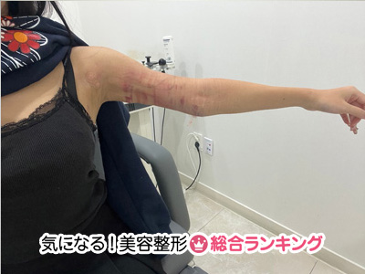 脂肪吸引翌日