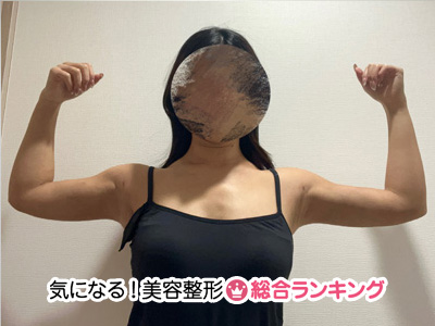 脂肪吸引3か月