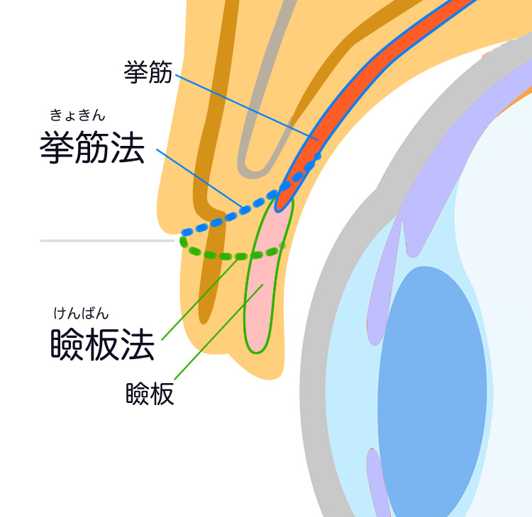 瞼板法と挙筋法の違い