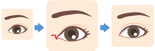 目頭切開とは