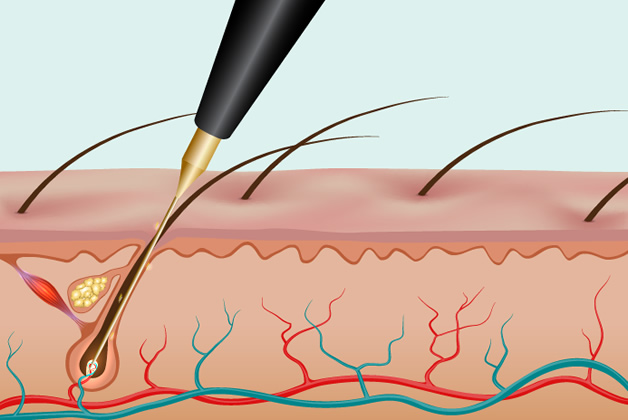 ニードル脱毛（電気針脱毛）のしくみ