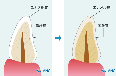 生まれつき、または加齢による黄ばみ 生まれつき、または加齢による黄ばみ