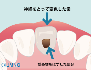 根管内の薬剤を取り除く 根管内の薬剤を取り除く