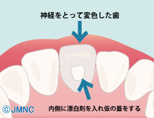 ホワイトニング剤を詰める ホワイトニング剤を詰める