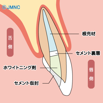 薬剤の交換 薬剤の交換