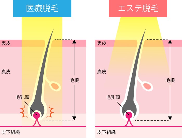【脱毛 5】医療脱毛と美容脱毛（エステ脱毛）の違い