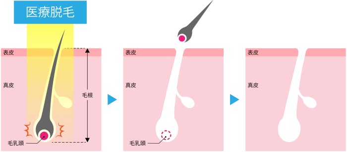 医療レーザーで脱毛する仕組み 医療レーザーで脱毛する仕組み