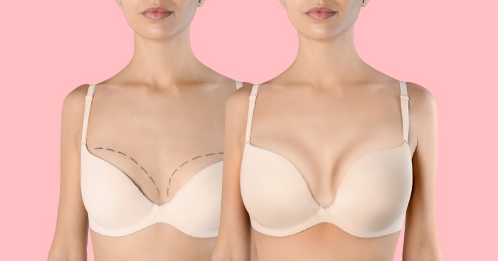 【まとめ】豊胸の種類によるメリットやデメリット!比較しておすすめを解説 【まとめ】豊胸の種類によるメリットやデメリット!比較しておすすめを解説
