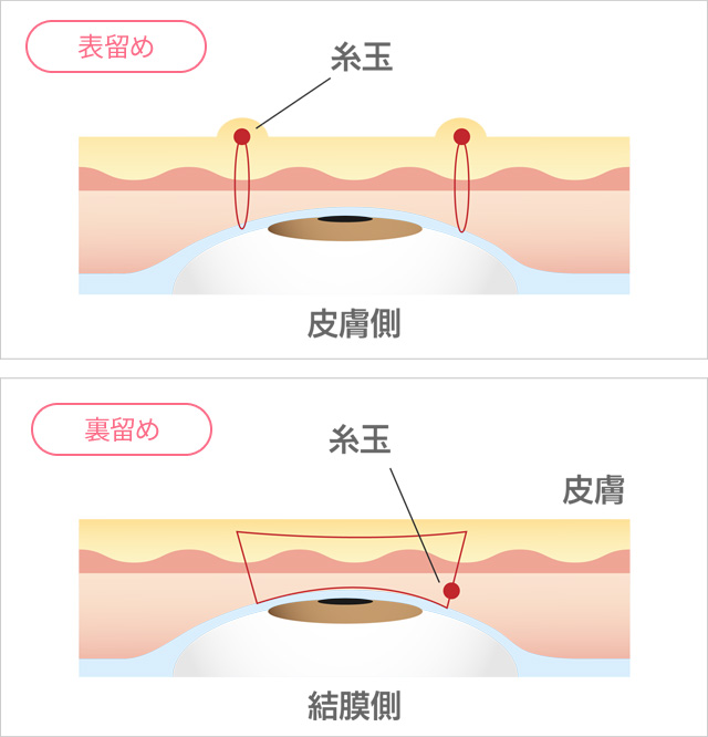 ③まぶたに傷跡がつくか：表留め・裏留めの違い