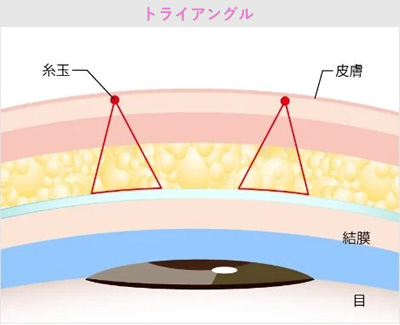 トライアングル